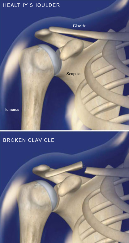 broken clavicle