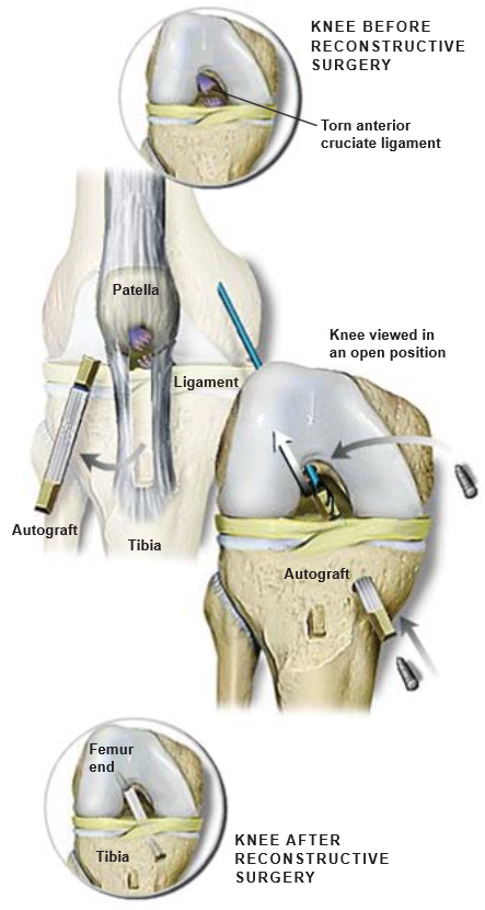 ACL-Reconstruction