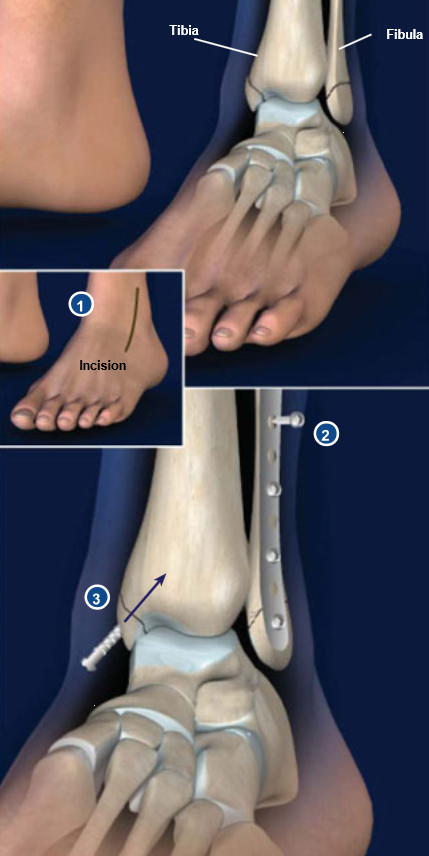Ankle-Fracture-Surgery