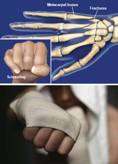 Fractures-Hand