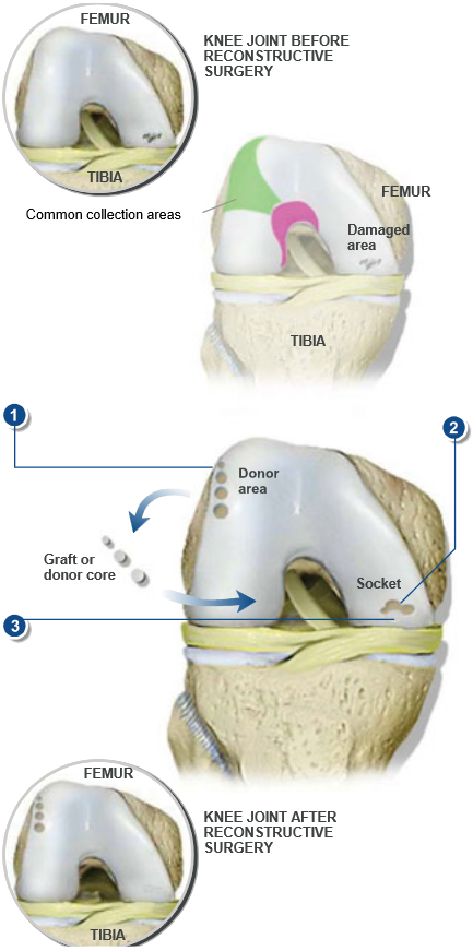 OATS-Cartilage-RepairSx