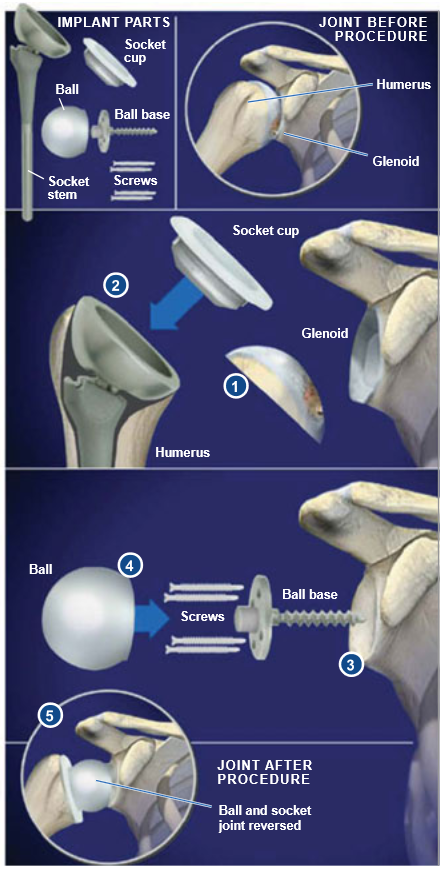 Reverse-Total-Shoulder-Replacement