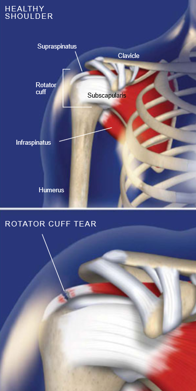 Rotator-Cuff-Tears