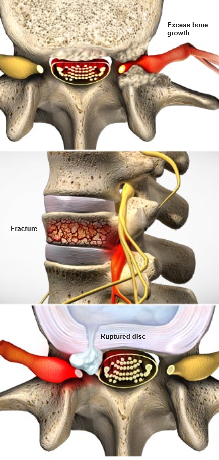 Estenosis espinal 2