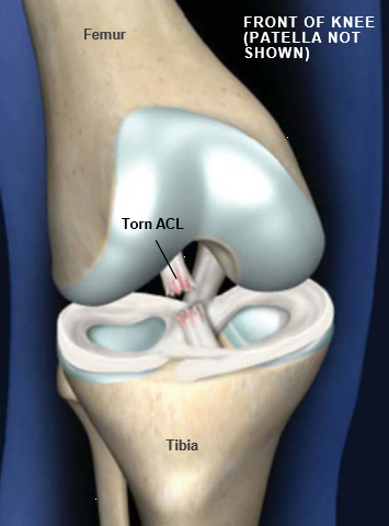 Torn-ACL