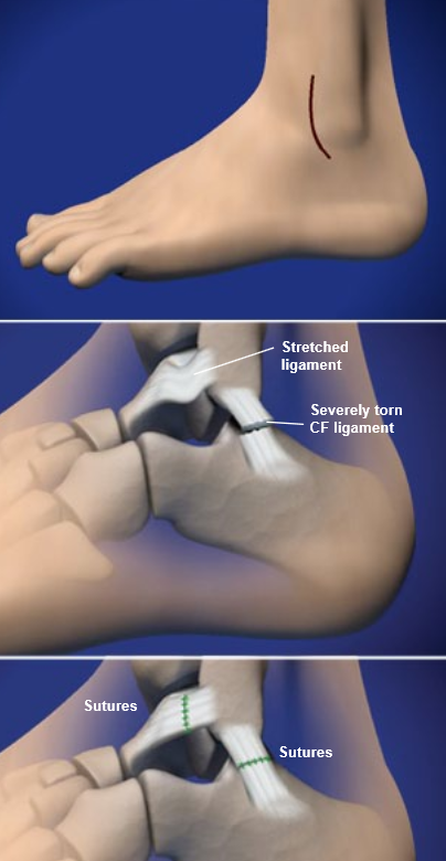 Reconstrucción del ligamento lateral del tobillo