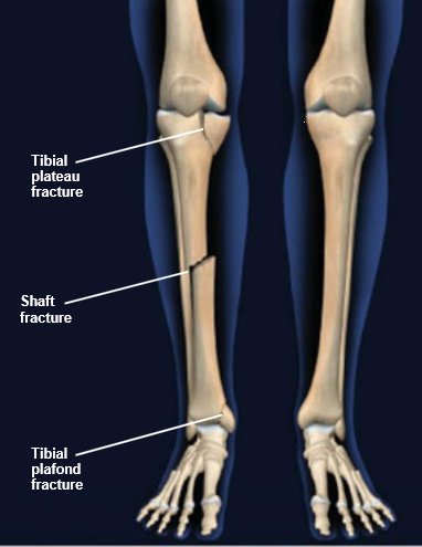 tibial-fractures
