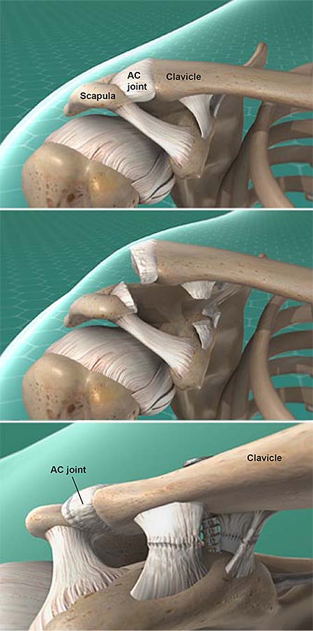 acromioclavicular-ac-joint-separation-repair