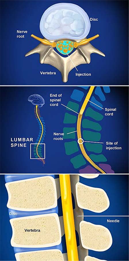 anesthesia-lumbar-puncture-spinal-anesthesia