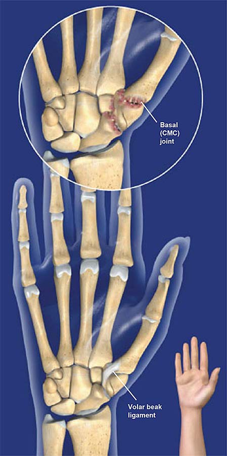 Basal-articular-osteoartritis