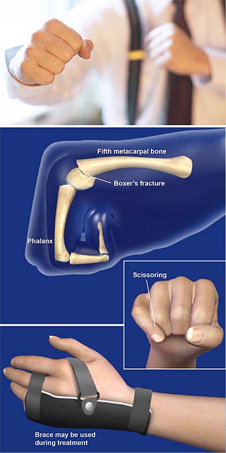 boxers-fracture