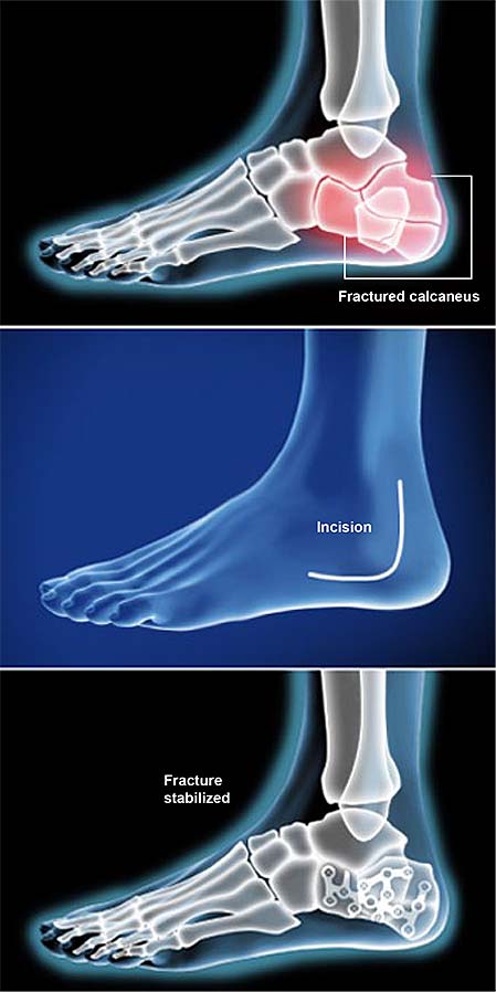 calcaneal-fracture-fixation-open-reduction-and-internal-fixation