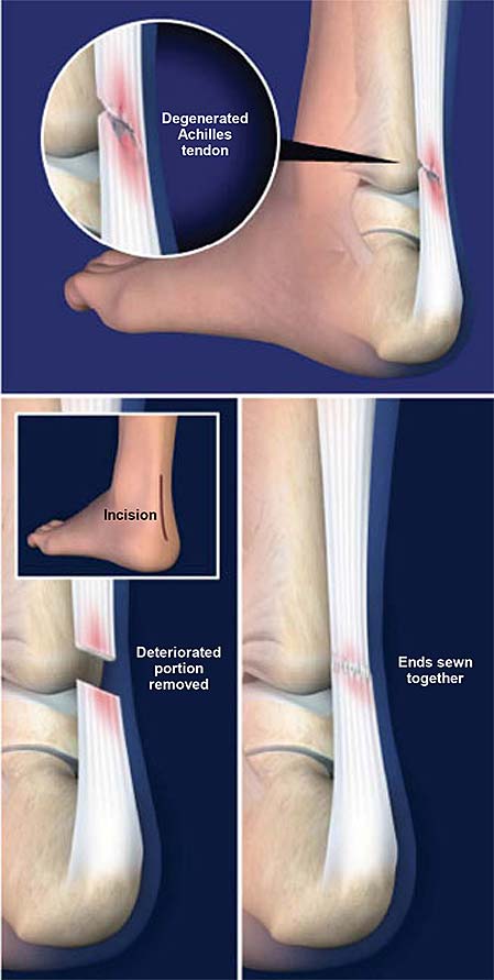 debridement-of-the-achilles-tendon