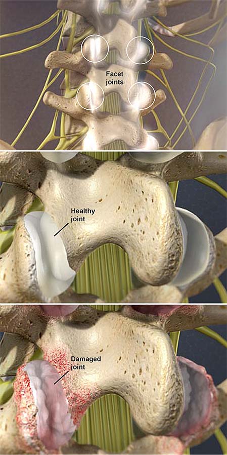 facet-joint-syndrome