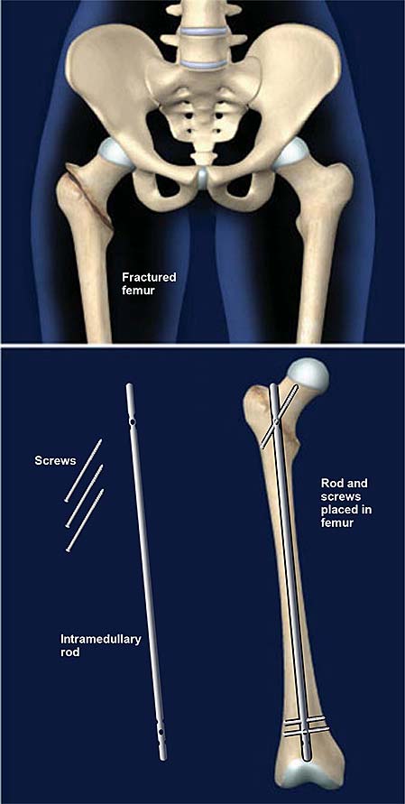 femur-fracture-fixation-with-intramedullary-rod