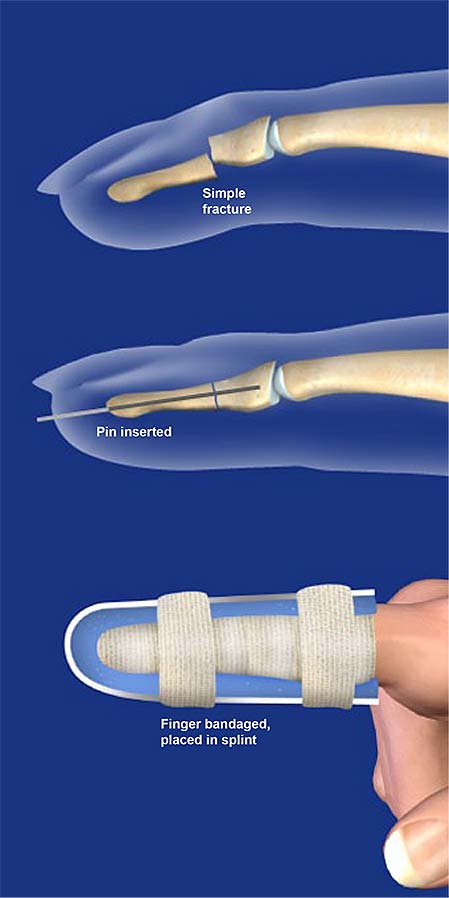 Fijación de fractura de dedo