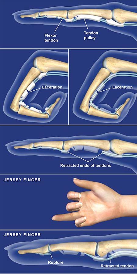 flexor-tendon-injuries