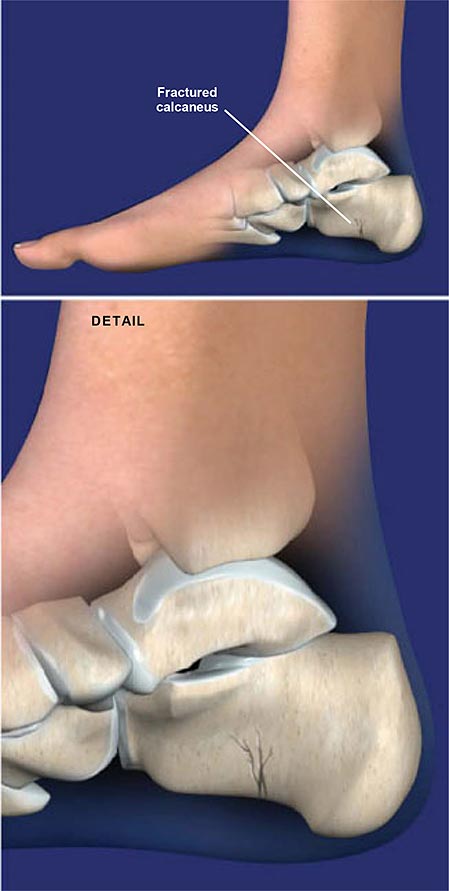 Fracture of the Heel Bone (Calcaneus)