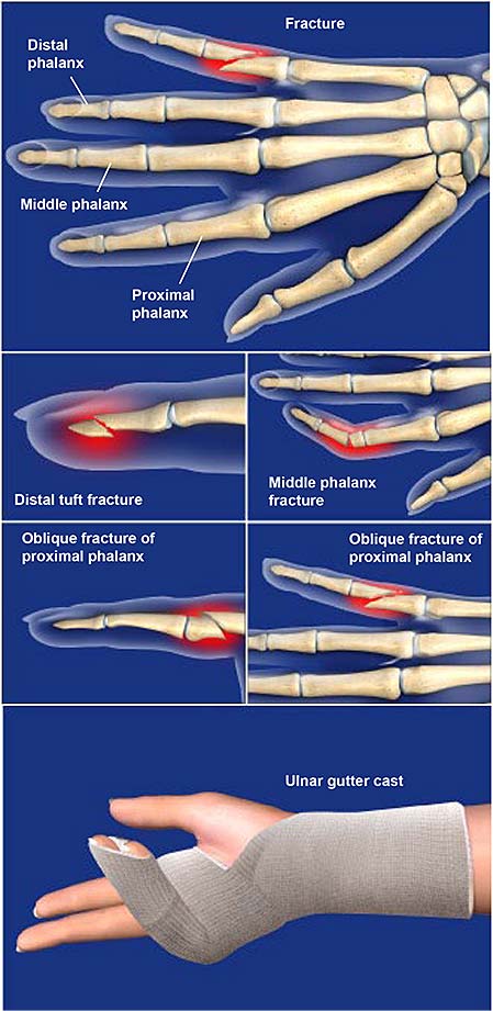 fractures-of-the-finger