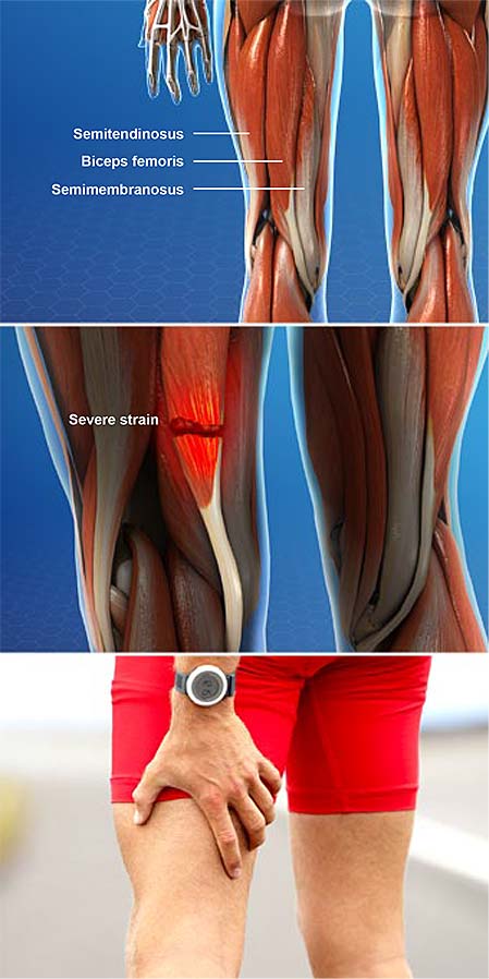 hamstring-muscle-injuries