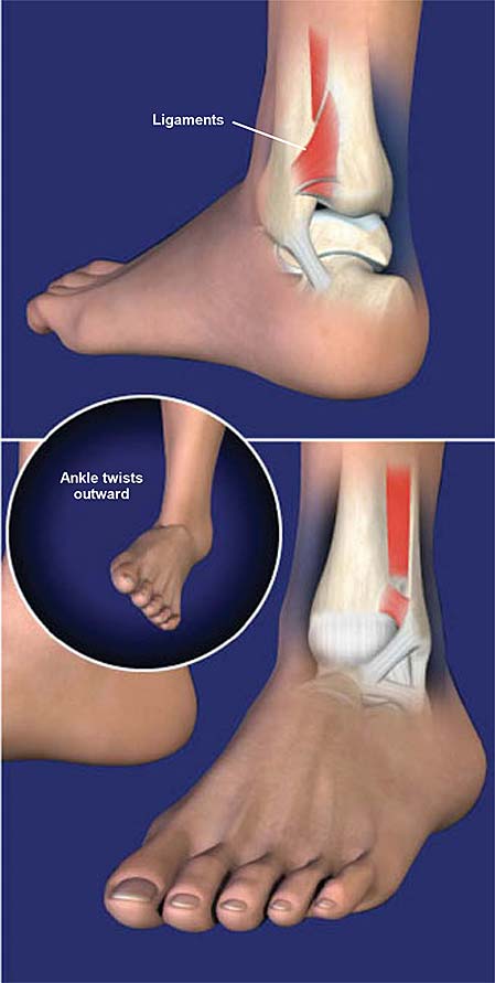 high-ankle-sprain-syndesmosis-ligament-injury