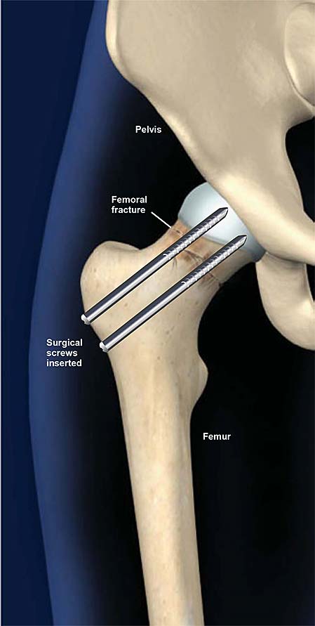 fractura de cadera, tratamiento con tornillos quirúrgicos