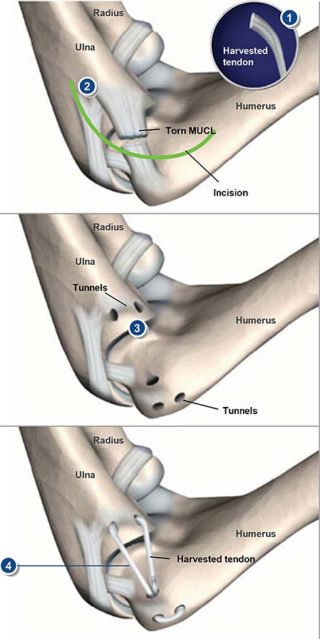Medial Ulnar Collateral Ligament Reconstruction (Tommy John Surgery)