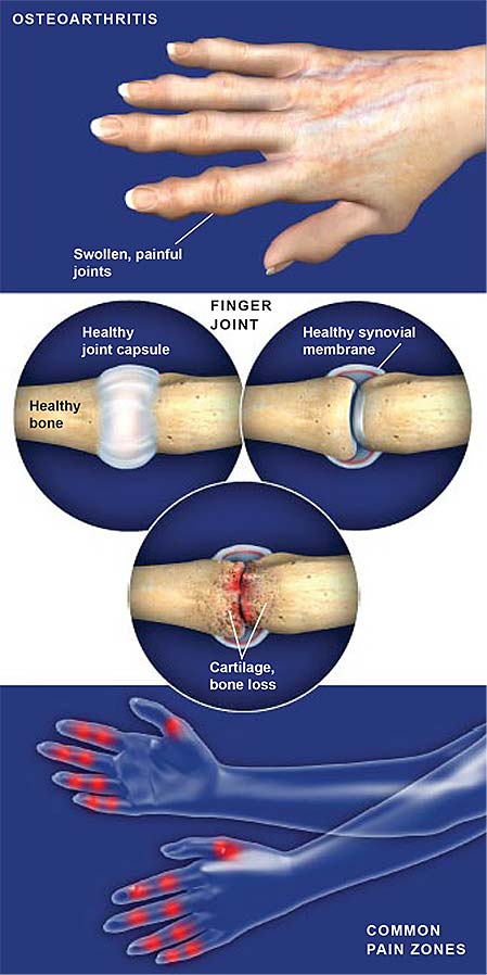 osteoarthritis-of-the-hand