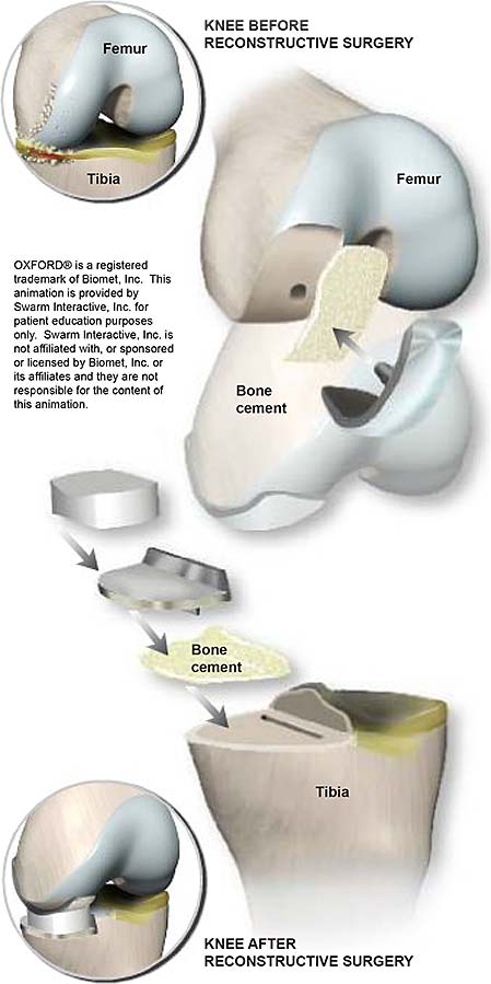reemplazo parcial de rodilla con oxford implant