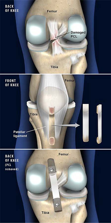posterior-cruciate-ligament-pcl-reconstruction