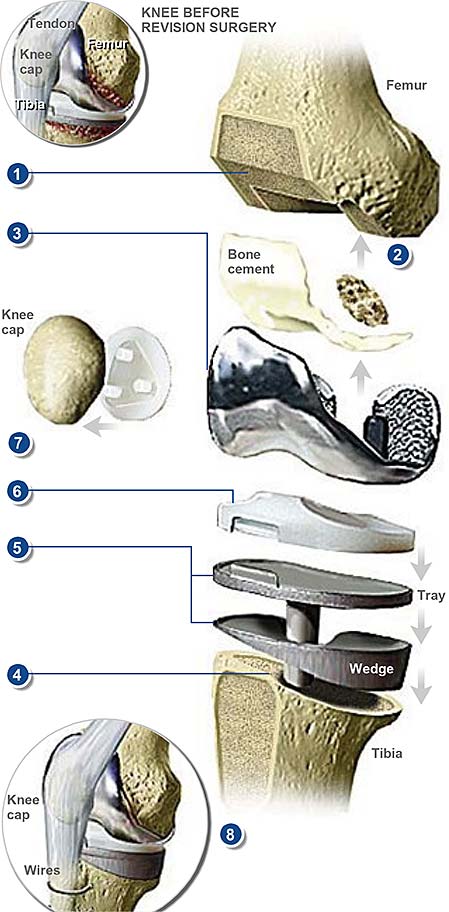 revision-knee-with-tibial-tubercle-osteotomy-1