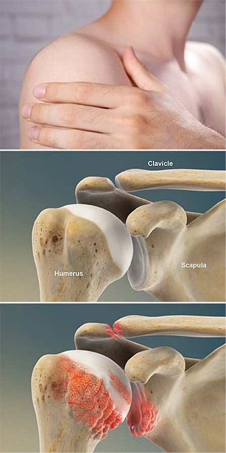 rheumatoid-arthritis-ra-of-the-shoulder