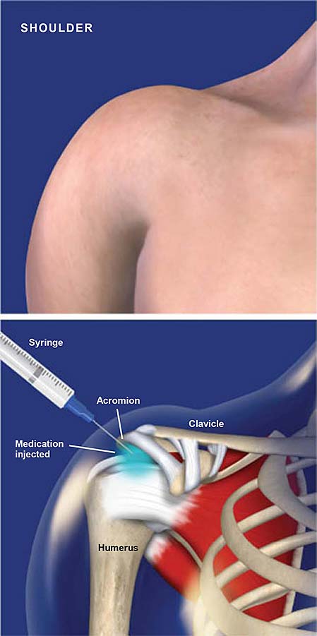 subacromial-injection