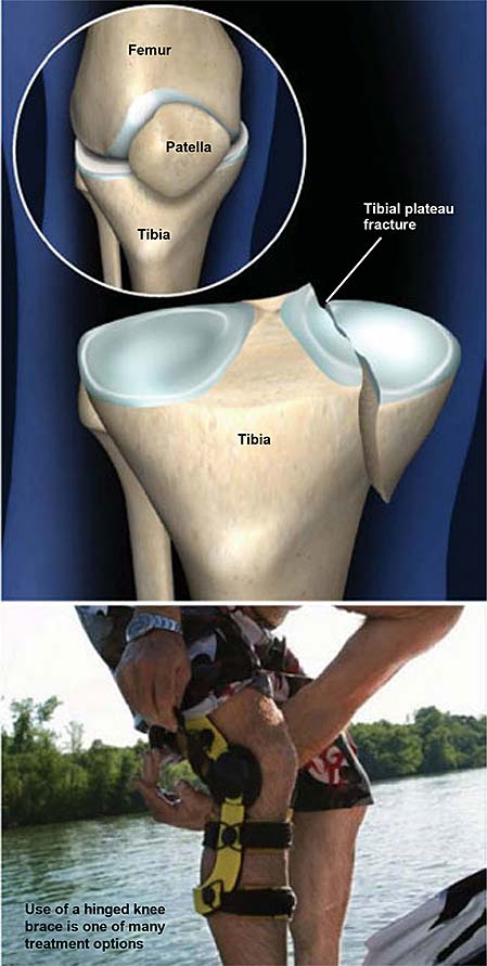 tibial-plateau-fracture