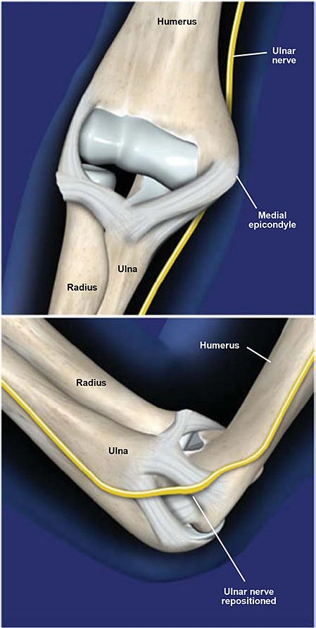 Ulnar Nerve Transposition at the Elbow