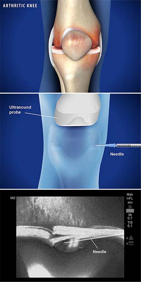 ultrasound-guided-injection-for-knee-pain