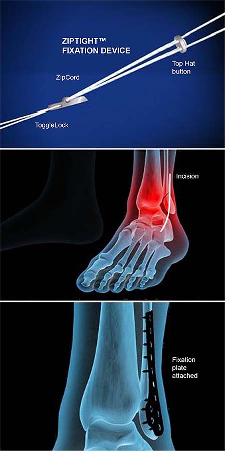 ziptight-fixation-for-ankle-syndesmosis-1