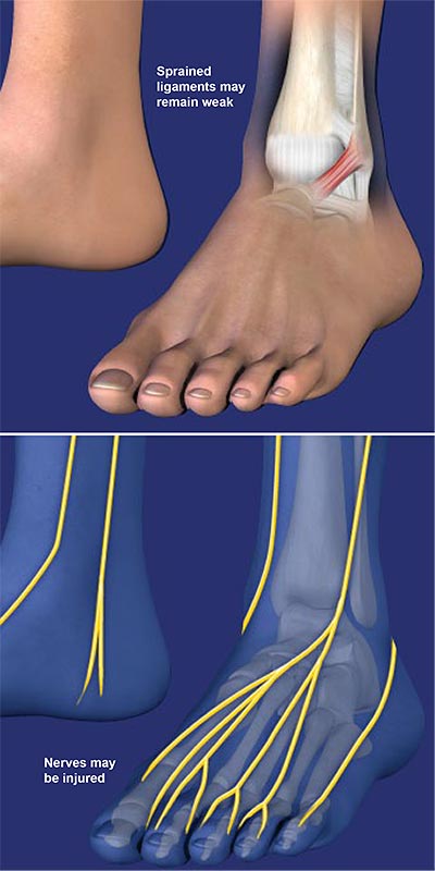 Chronic-Lateral-Ankle-Pain