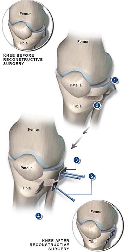 High-Tibial-Osteotomy