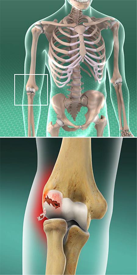 Osteochondritis Dissecans of the Elbow